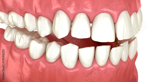 Lingual braces system, bite correction. 3D animation concept of golden braces photo