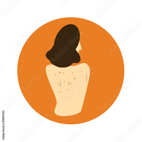 Illustration of woman back with skin problem.