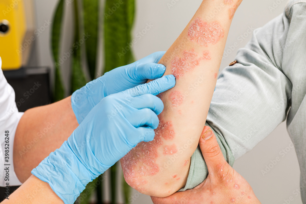 A dermatologist wearing gloves examines the skin of a sick patient