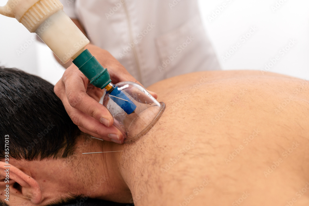 Unrecognized Physiotherapist Applying Cupping Techniques Unrecognized Physiotherapist Applying Cupping Techniques