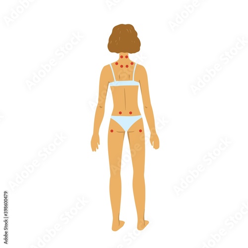 Tenders points of fibromyalgia. Vector illustration of woman body on white background.