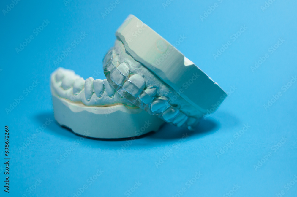 Gebissabdruck mit Zahnschiene