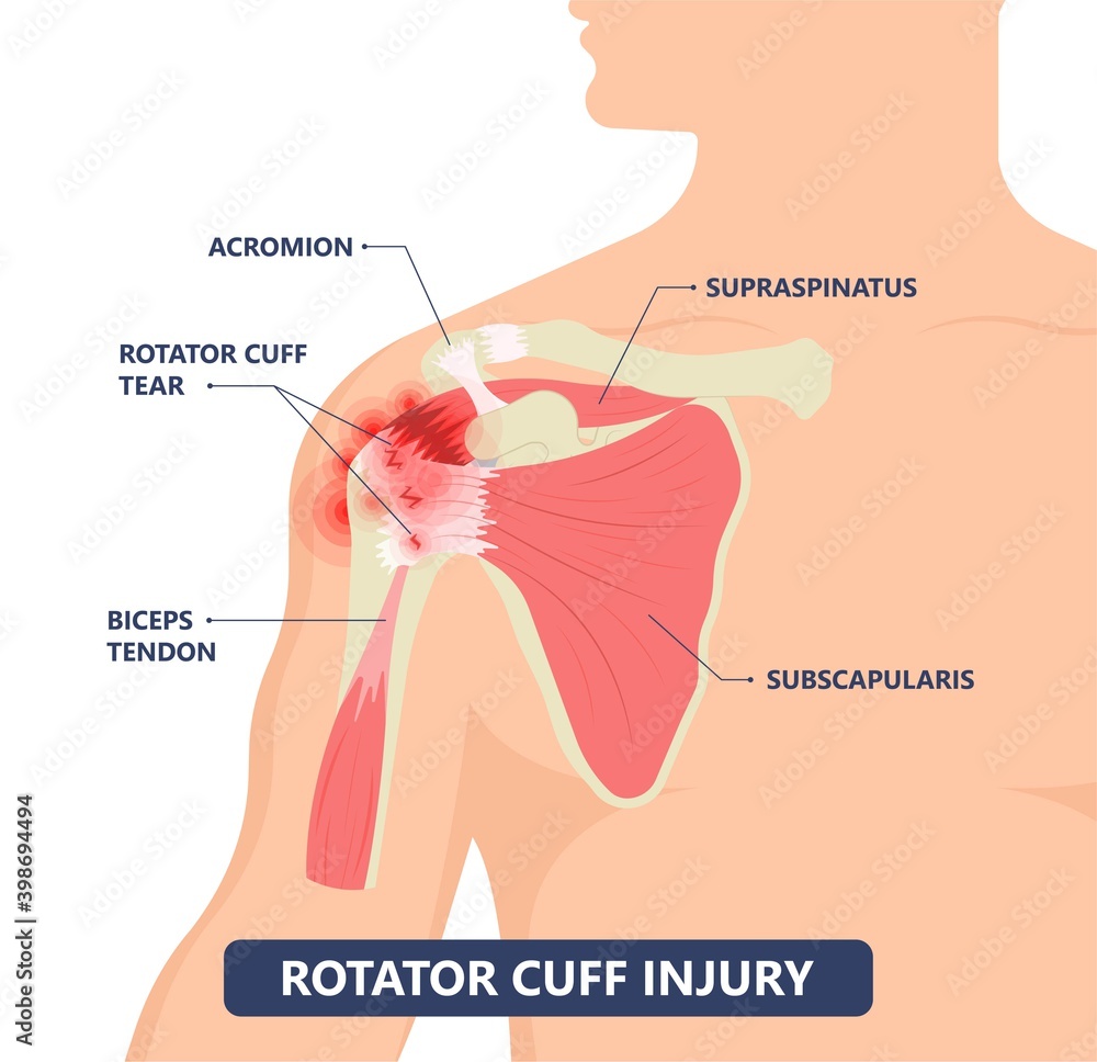 Vektorová grafika „Rotator Cuff Disease sport pain torn tear arm treat
