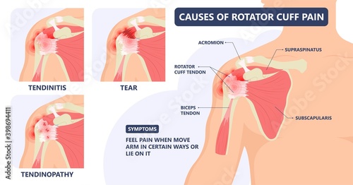 Rotator Cuff Disease sport pain torn tear arm treat frozen range of motion joint Chronic injuries heavy lifting sprain slap bicep problem degenerative bone tennis stiffness spur Physical therapy