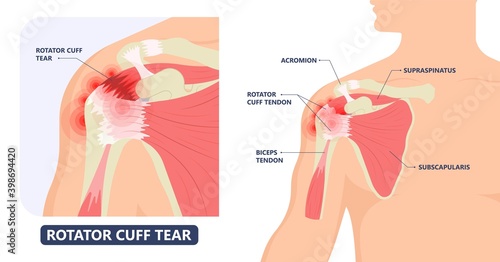 Rotator Cuff Disease sport pain torn tear arm treat frozen range of motion joint Chronic injuries heavy lifting sprain slap bicep problem degenerative bone tennis stiffness spur Physical therapy