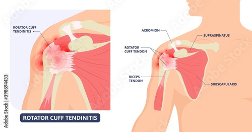 Rotator Cuff Disease sport pain torn tear arm treat frozen range of motion joint Chronic injuries heavy lifting sprain slap bicep problem degenerative bone tennis stiffness spur Physical therapy