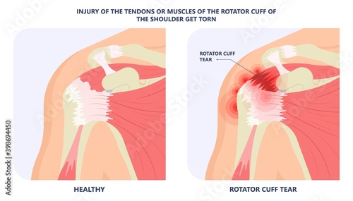 Rotator Cuff Disease sport pain torn tear arm treat frozen range of motion joint Chronic injuries heavy lifting sprain slap bicep problem degenerative bone tennis stiffness spur Physical therapy