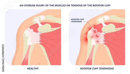 Rotator Cuff Disease sport pain torn tear arm treat frozen range of motion joint Chronic injuries heavy lifting sprain slap bicep problem degenerative bone tennis stiffness spur Physical therapy