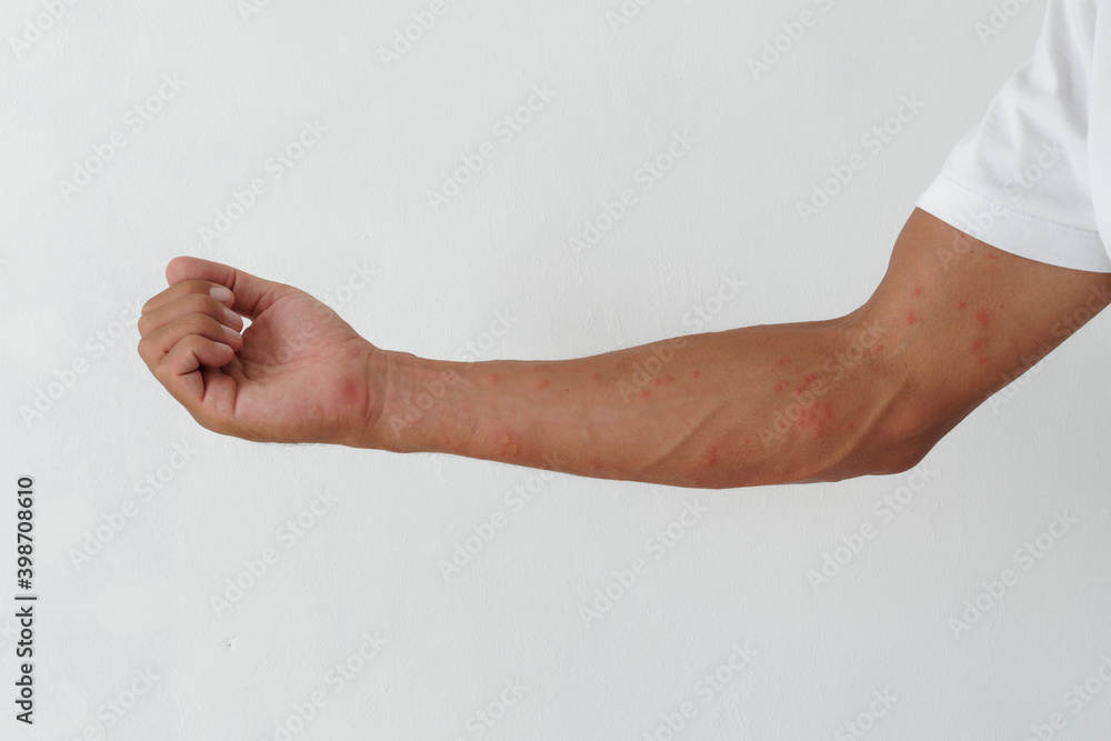 Skin rash, rashes caused by allergic reactions on arms. Skin rash, rashes caused by allergic reactions on arms.