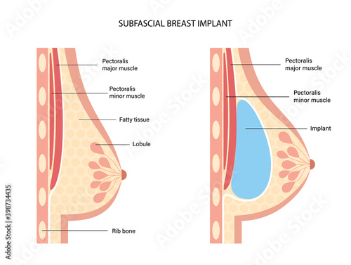 Breast Implant Concept
