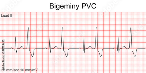 Electrocardiogram show ventricular fibrillation (VF) pattern. Cardiac fibrillation. Heart beat. CPR. ECG. EKG. Vita