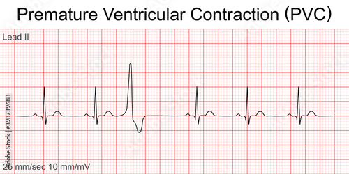 Electrocardiogram show ventricular fibrillation (VF) pattern. Cardiac fibrillation. Heart beat. CPR. ECG. EKG. Vita