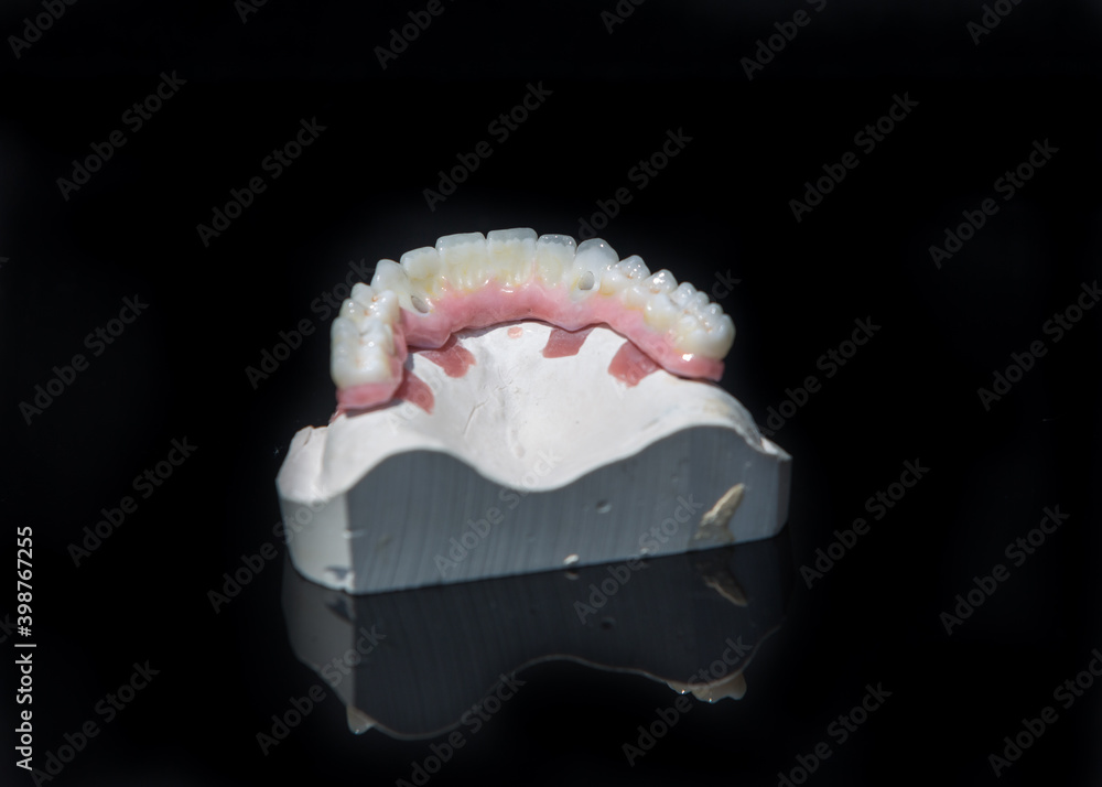 Ceramic teeth dental crowns model on black background.