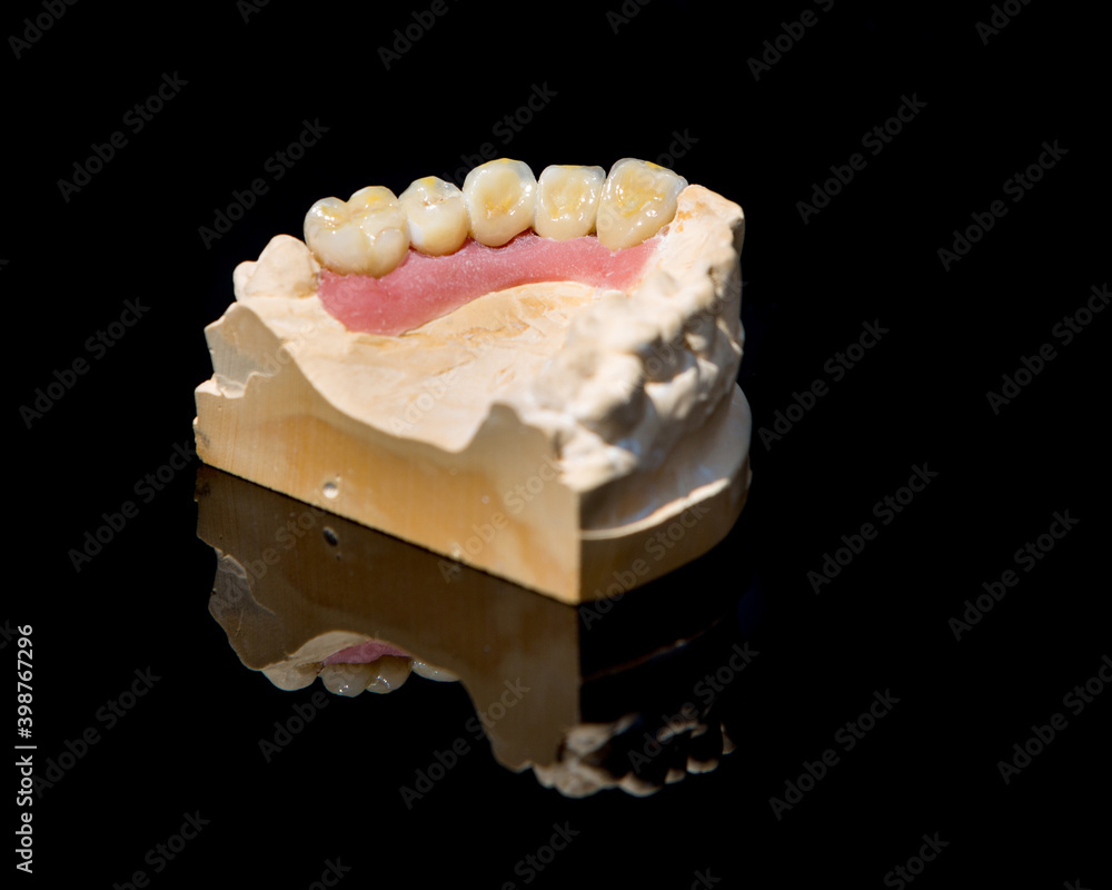 Ceramic teeth dental crowns model on black background.