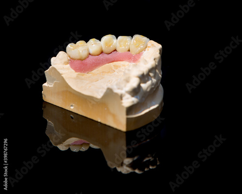 Obraz na płótnie Ceramic teeth dental crowns model on black background. w salonie
