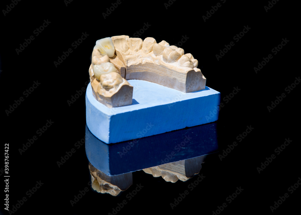 Ceramic teeth dental crowns model on black background.