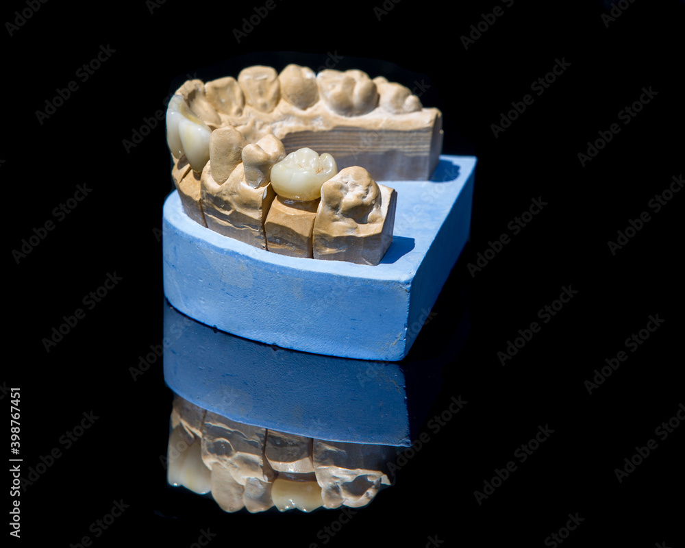 Ceramic teeth dental crowns model on black background.