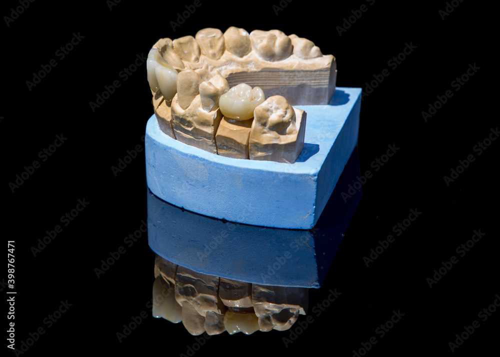 Ceramic teeth dental crowns model on black background.