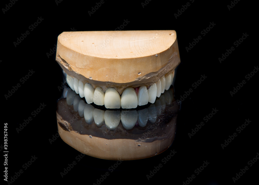 Ceramic teeth dental crowns model on black background.