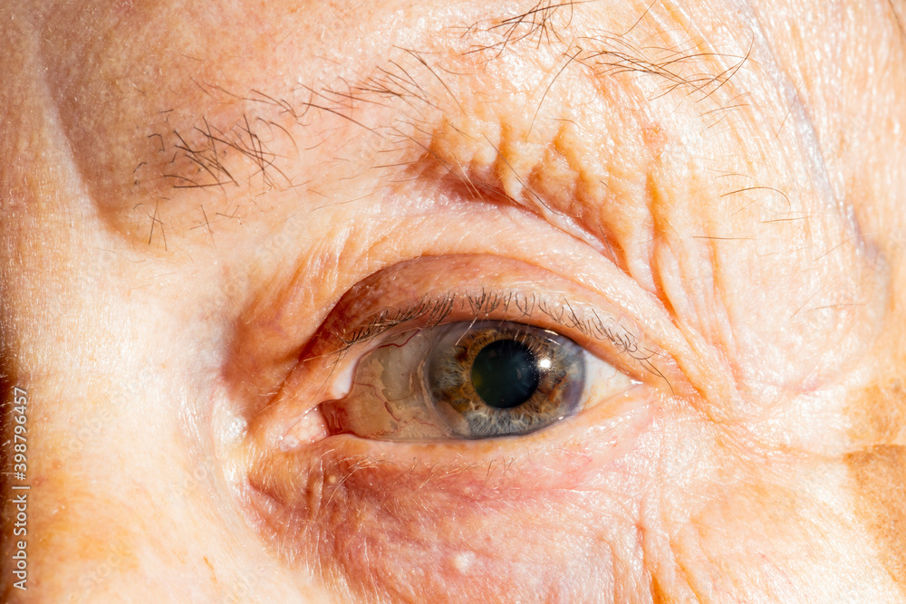 Image of an eye of an elderly woman with vision problems. in the eye the capillaries are distinguished Image of an eye of an elderly woman with vision problems. in the eye the capillaries are distinguished