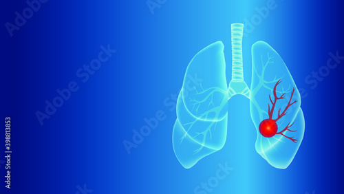 Human lungs with the disease.