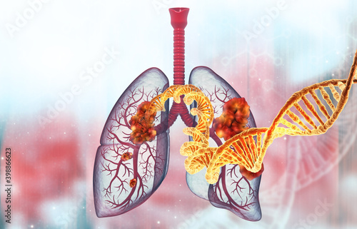 Human lung cancer with dna strand. 3d illustration.