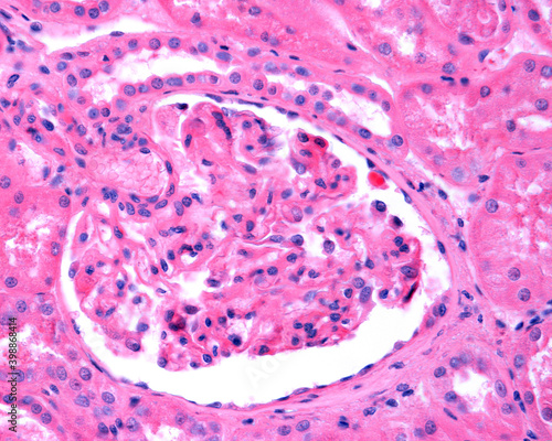 Kidney. Membranous glomerulonephritis photo