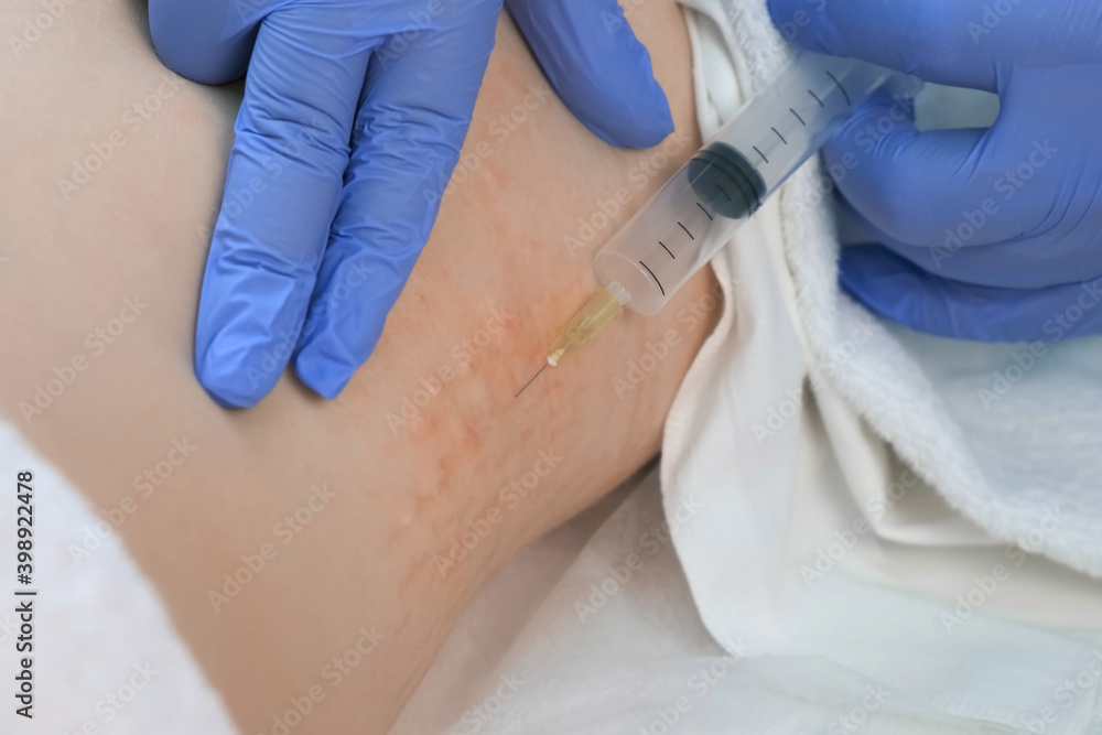 Ozone Inj Doctor makes injection of ozone gas in patient woman on side of body on ...