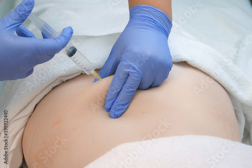 Doctor makes injection of ozone gas in patient's woman back against stretches on ozone therapy, closeup view. Treatment, cure and remove of skin tags and stretches. Cosmetologist woman in gloves. photo