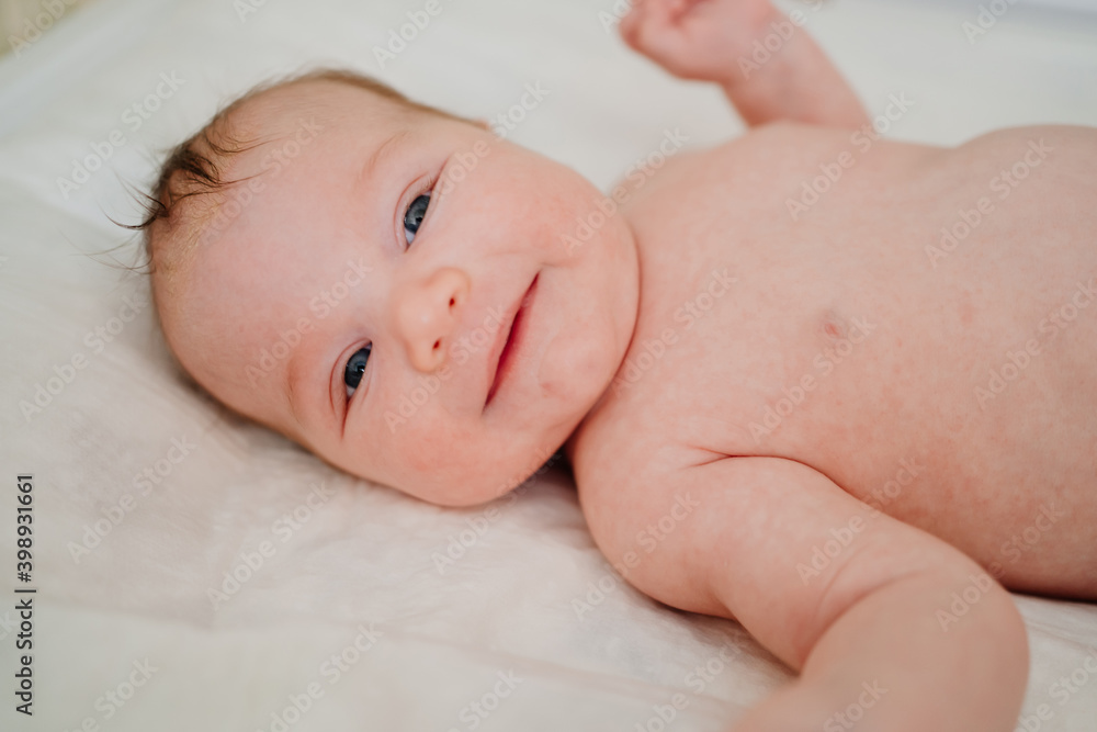A baby with seborrheic dermatitis on his head rests on a white sheet. childcare. A baby with seborrheic dermatitis on his head rests on a white sheet. childcare.