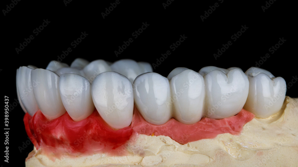 ceramic veneers of the upper jaw side view of the model, photo on a black background ceramic veneers of the upper jaw side view of the model, photo on a black background