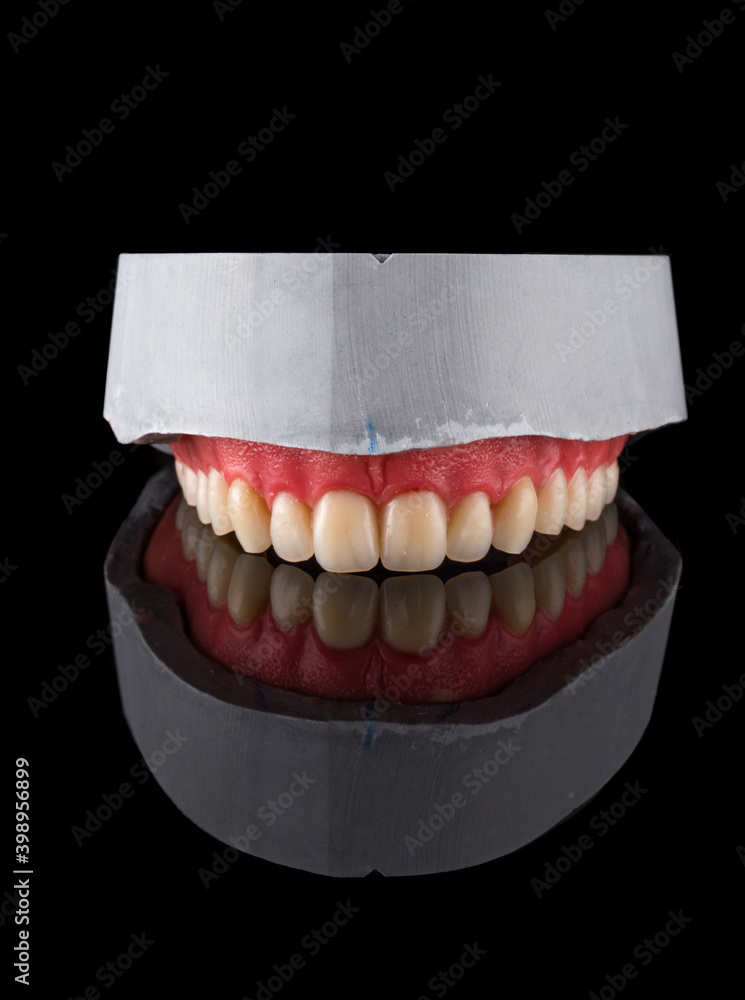 Complete maxillary denture WaxUp and Gingival Contouring Stock Photo