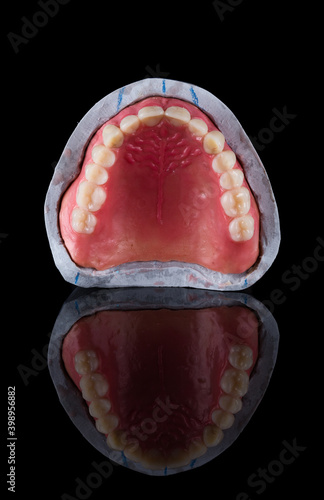 Complete maxillary denture – Wax-Up and Gingival Contouring