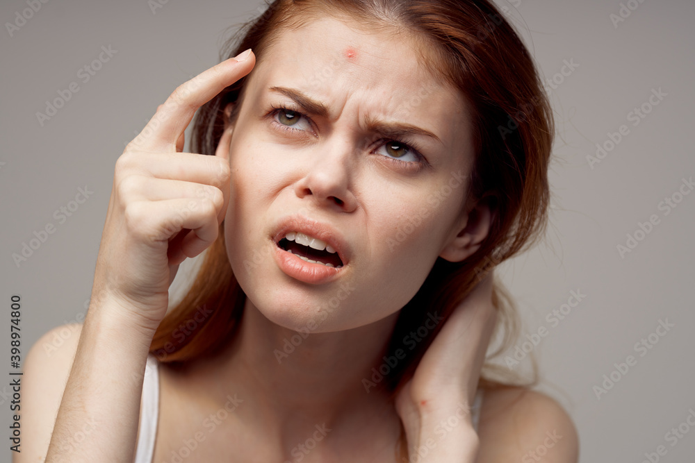 Fototapeta premium surprised woman with acne on her face health problems acne