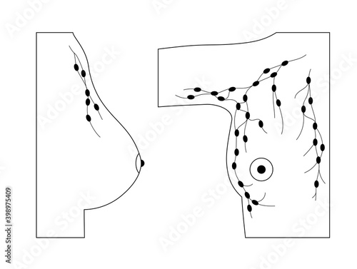 Breast disease concept
