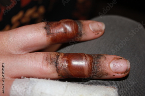 burned fingers with big blisters