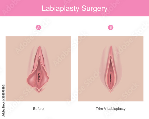 labiaplasty surgery. Illustration for medical use explain a procedure surgery to decrease the size of inner tissues the female genitalia.. photo
