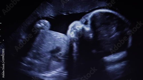 Footage Ultrasonography of third trimester pregnancy