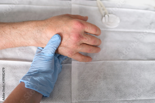 Close up of male hands with dry skin damage. nurse treats wounds. Dermatology concept