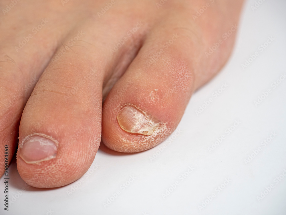 close-up of toes with nail problems. Infection, cracks, improper care. Nail care concept close-up of toes with nail problems. Infection, cracks, improper care. Nail care concept