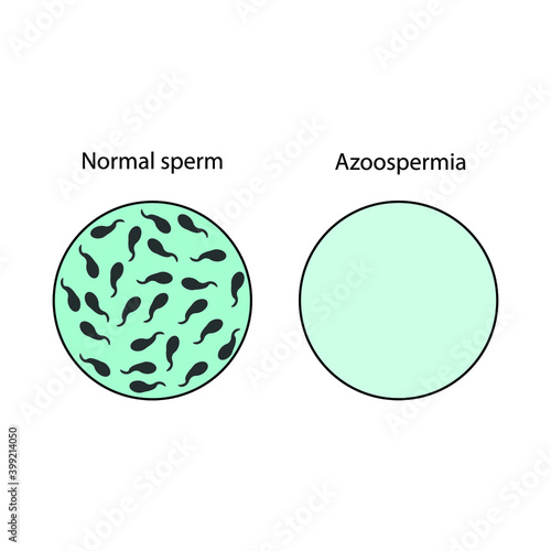semen analysis, normal sperm and azoospermia. male reproductive system concept. Flat illustration. photo