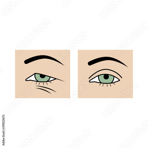 Upper eyelid blepharoplasty before and after, comparison. Drooping eyelid