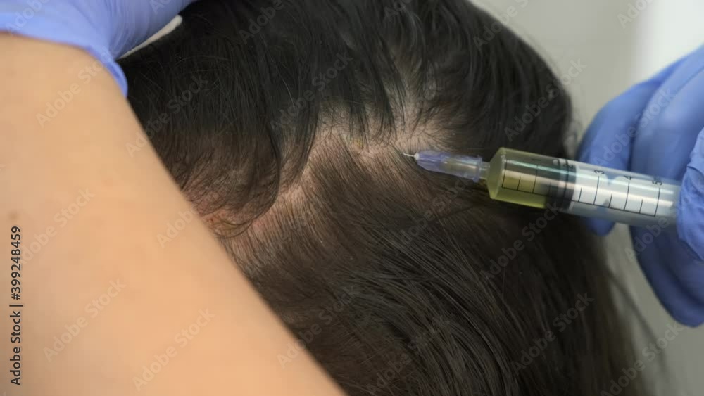 Doctor trichologist making injections mesotherapy with vitamins in