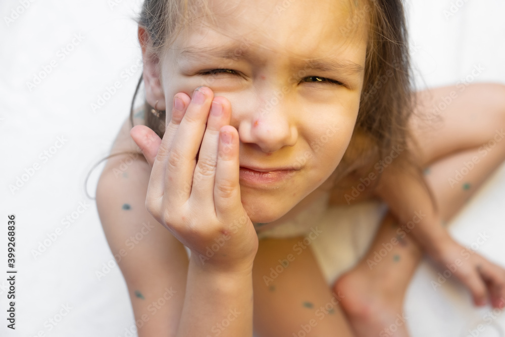 Portrait of little girl with pox . Sick child with chickenpox. Young