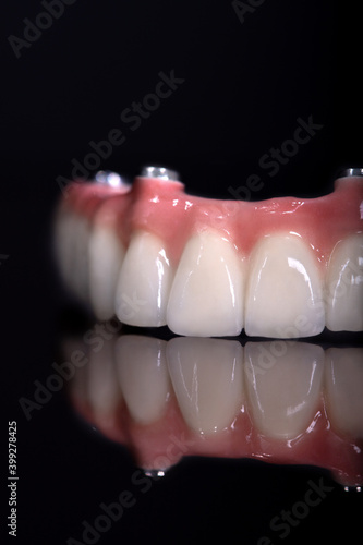 Beautiful upper teeth ceramic press ceramic crowns and veneers on the dental stone model zircon arch ceramic prothesis Implants . Dental restoration treatment clinic patient. oral surgery dentist