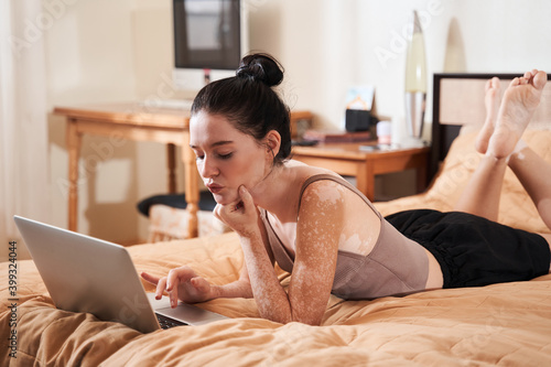 Woman with autoimmune disease vitiligo working on a laptop photo