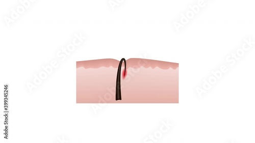 Ingrown hairs after depilation
