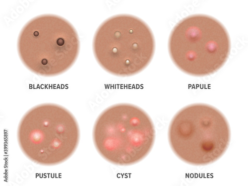 Acne types on dark skin, face pimples and comedones, vector blackheads and pore cysts. Skin acne types, cosmetology and skincare treatment