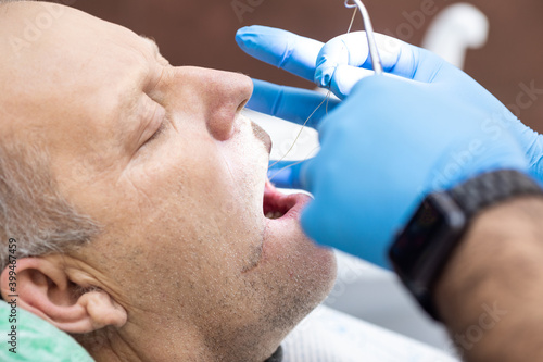 Dentist doctor sutures after tooth extraction from patient