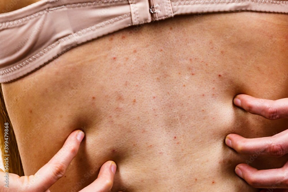Naklejka premium Woman with skin problem acne on back